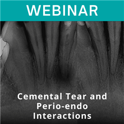 Webinar - Cemental Tear and Perio-endo Interactions